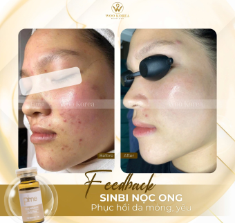 Da mỏng v&agrave; nguy&ecirc;n nh&acirc;n | Phục hồi da mỏng gi&aacute; rẻ tại spa H&agrave; Nội