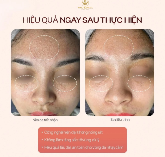 Đốt mụn thịt n&ecirc;n ki&ecirc;ng ăn g&igrave;? Đốt mụn thịt gi&aacute; rẻ H&agrave; Nội
