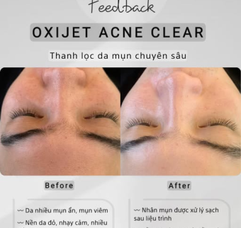 Trị mụn ẩn tại spa | Trị mụn gi&aacute; rẻ tại Wookorea Beauty Spa