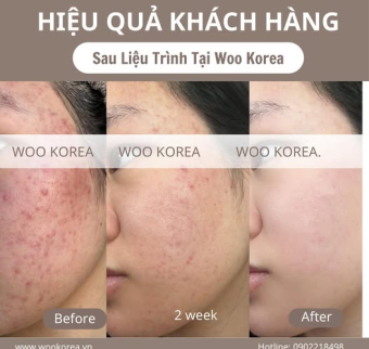 Trị mụn kh&ocirc;ng bong tr&oacute;c | Trị mụn gi&aacute; rẻ tại Spa H&agrave; Nội