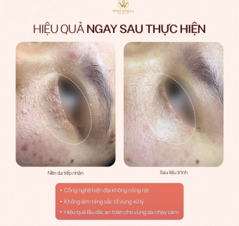 Đốt mụn thịt gi&aacute; rẻ tại H&agrave; Nội | Đốt nuốt ruồi nhanh ch&oacute;ng tại spa