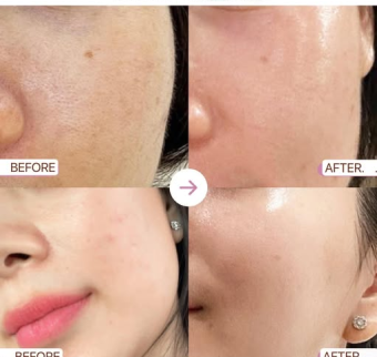 Meso Therapy khi n&agrave;o mới hiệu quả | Ti&ecirc;m meso gi&aacute; rẻ tại H&agrave; Nội
