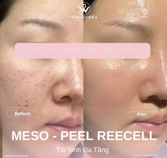 Hiệu quả liệu tr&igrave;nh meso v&agrave; peel reecell | Spa chất lượng tại H&agrave; Nội
