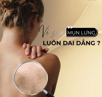 Trị mụn lưng hiệu quả tại spa | Spa trị mụn lưng gi&aacute; rẻ H&agrave; Nội