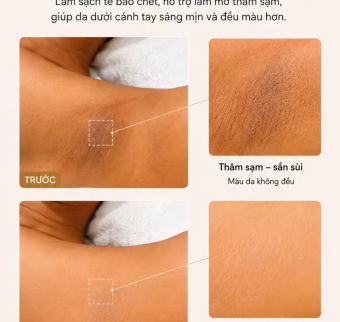Peel da trị th&acirc;m dưới c&aacute;ch tay | Peel n&aacute;ch tại Spa H&agrave; Nội