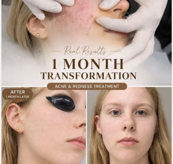 Trị mụn cho kh&aacute;ch du lịch H&agrave; Nội | Spa trị mụn chất lượng tại H&agrave; Nội