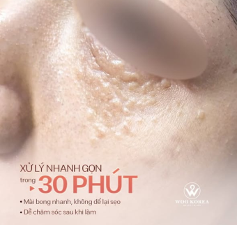 Mụn thịt ở cổ c&oacute; tự hết kh&ocirc;ng? Xử l&iacute; mụn thịt tại Spa - H&agrave; Nội