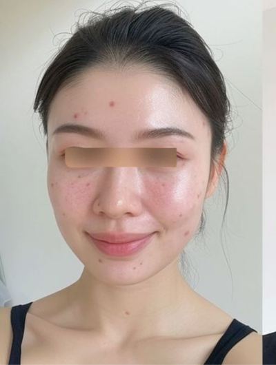 trãi nghiệm 1 tháng điều trị