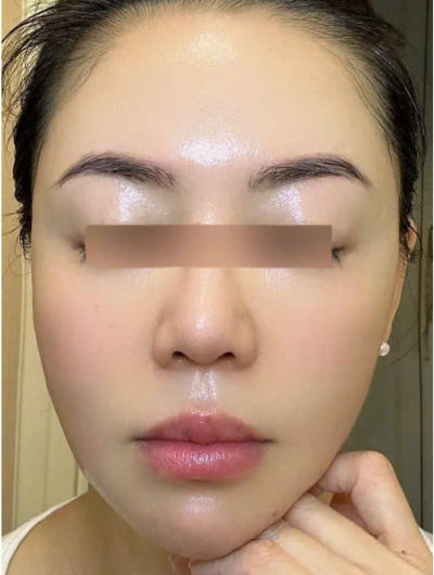 điều trị cho chị khách tại hà nội