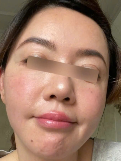 điều trị cho chị khách tại hà nội