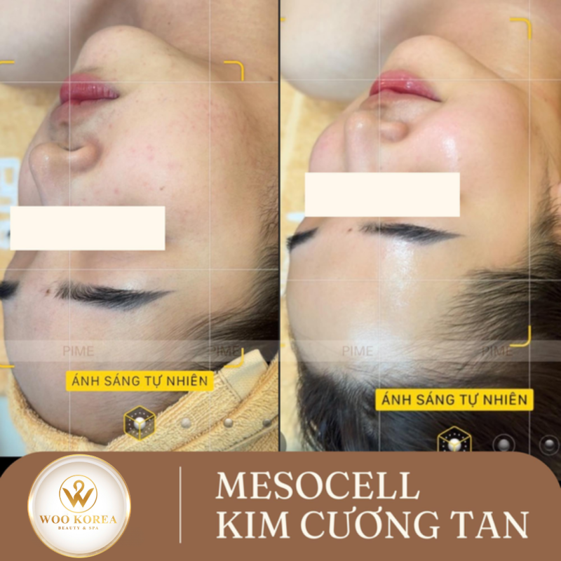 Mesocell Kim Cương Tan căng bóng (1h30p)