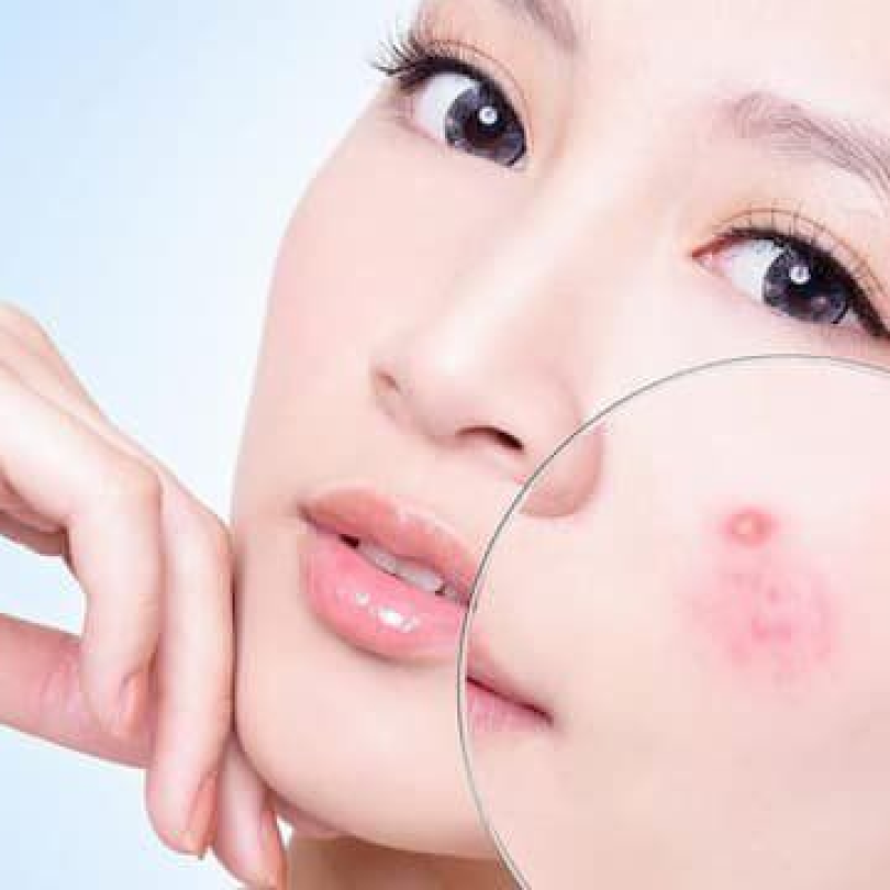 Liệu trình điều trị mụn (Tùy vào tình trạng viêm da) 7tr-15tr (10 buổi)