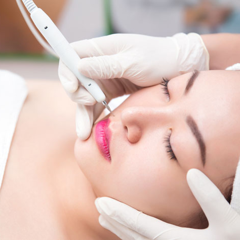 Đốt mụn thịt/nốt ruồi