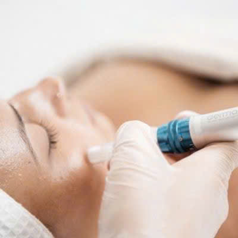 Meso Therapy Tái Cấu Trúc Siêu Cấp