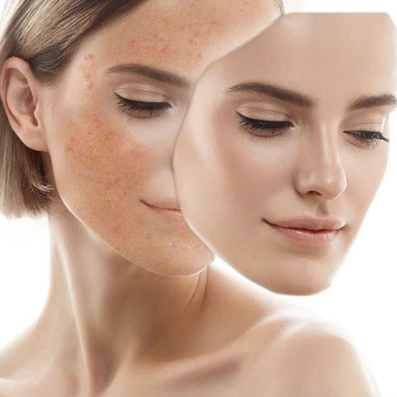 Peel Reecell Tái sinh đa tầng