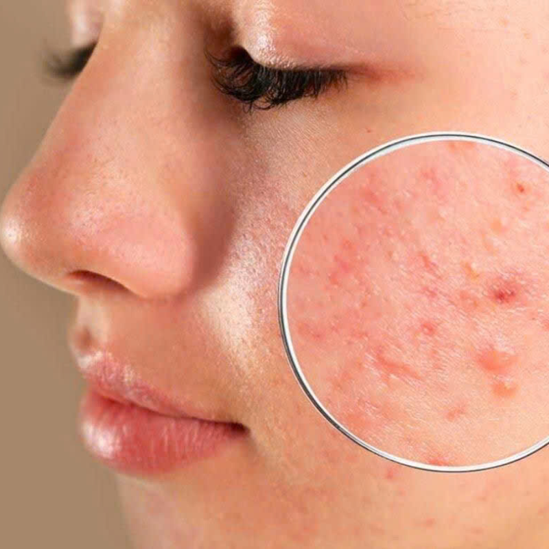 Liệu Tr&igrave;nh Trị Mụn Chuy&ecirc;n S&acirc;u 10 Buổi C&aacute; Nh&acirc;n H&oacute;a ✨ Giảm Mụn &ndash; Phục Hồi Da &ndash; Ngừa T&aacute;i Ph&aacute;t