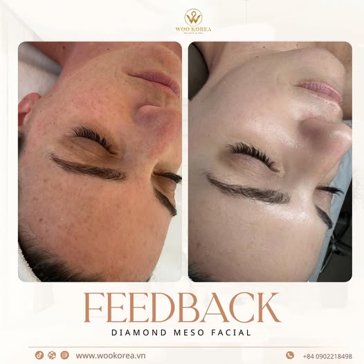 meso trị nám