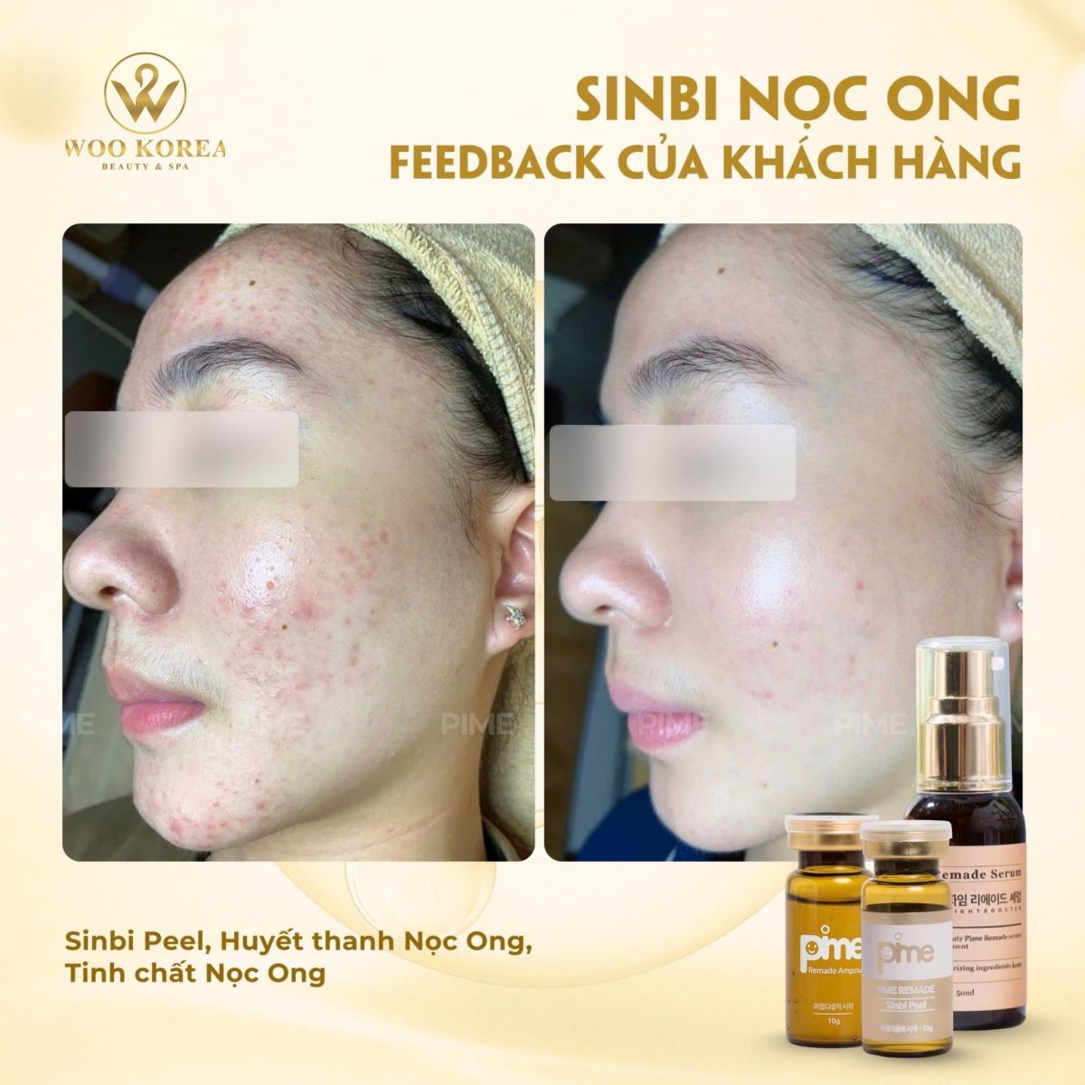 trị mụn