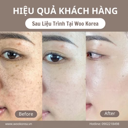 meso trị nám