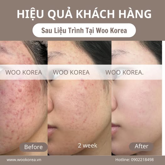 trị mụn