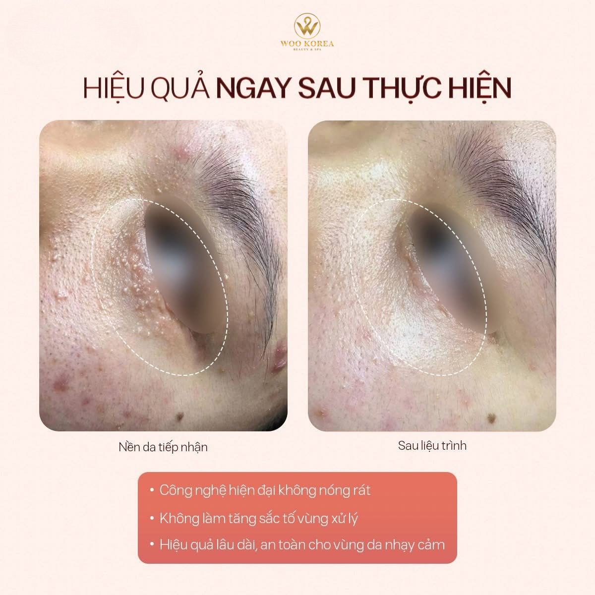 đốt mụn thịt