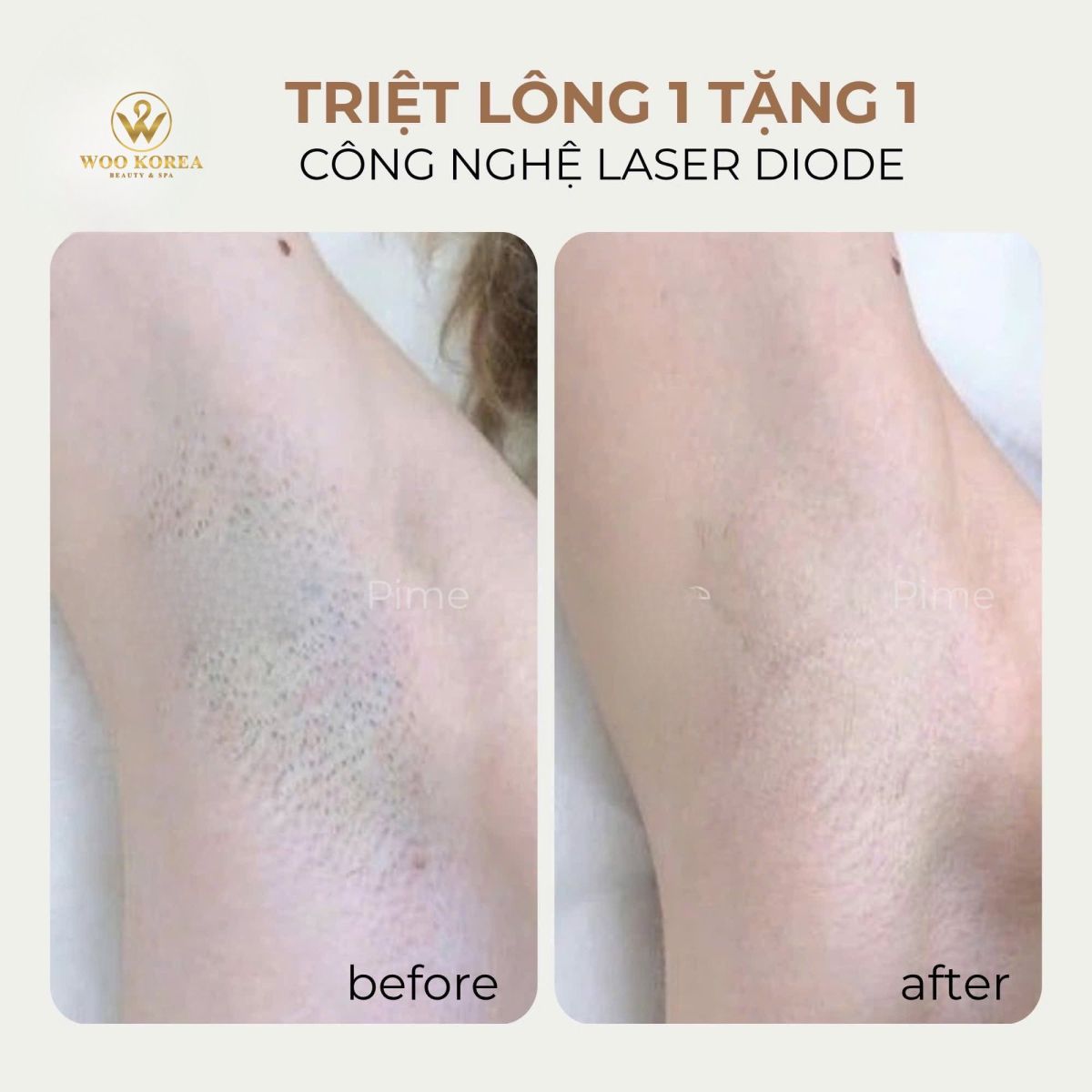 triệt lông