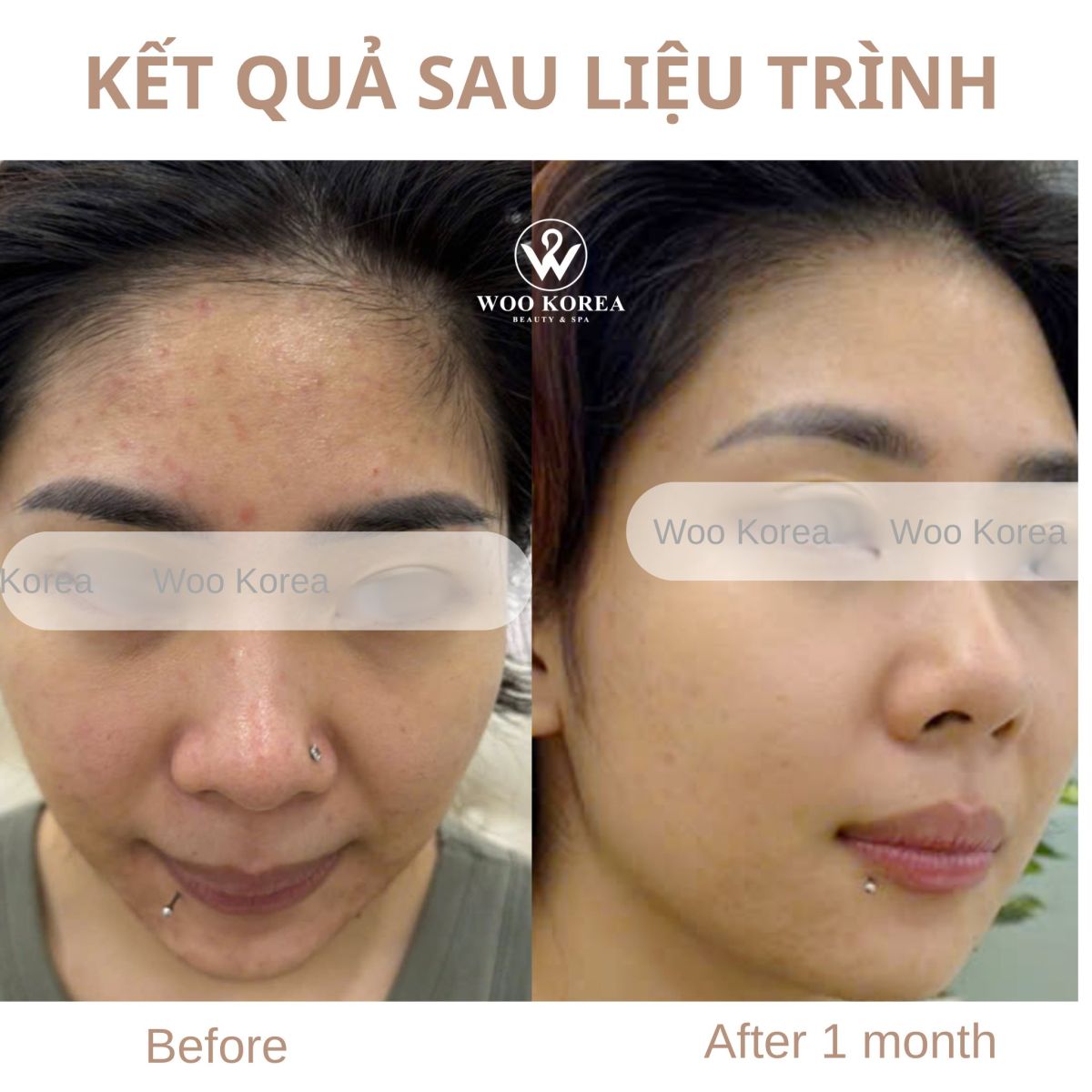 mụn ẩn