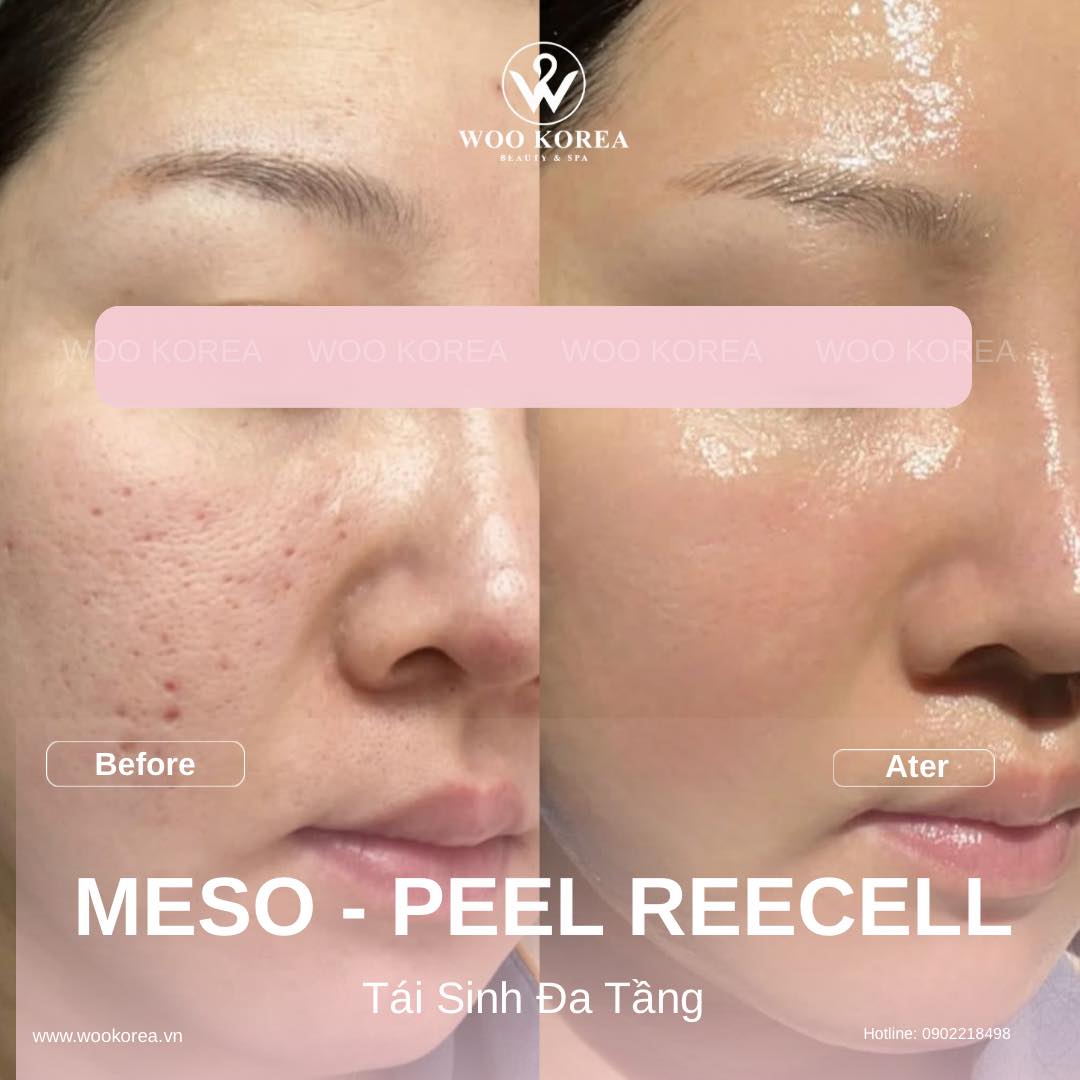 meso và peel