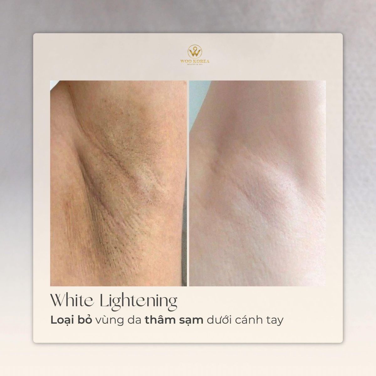 peel nách trị thâm
