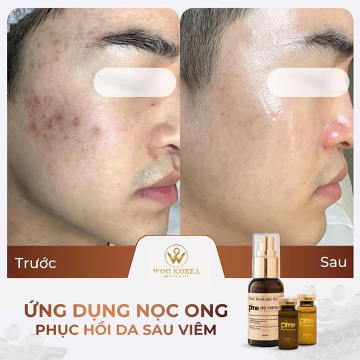 peel da nọc ong