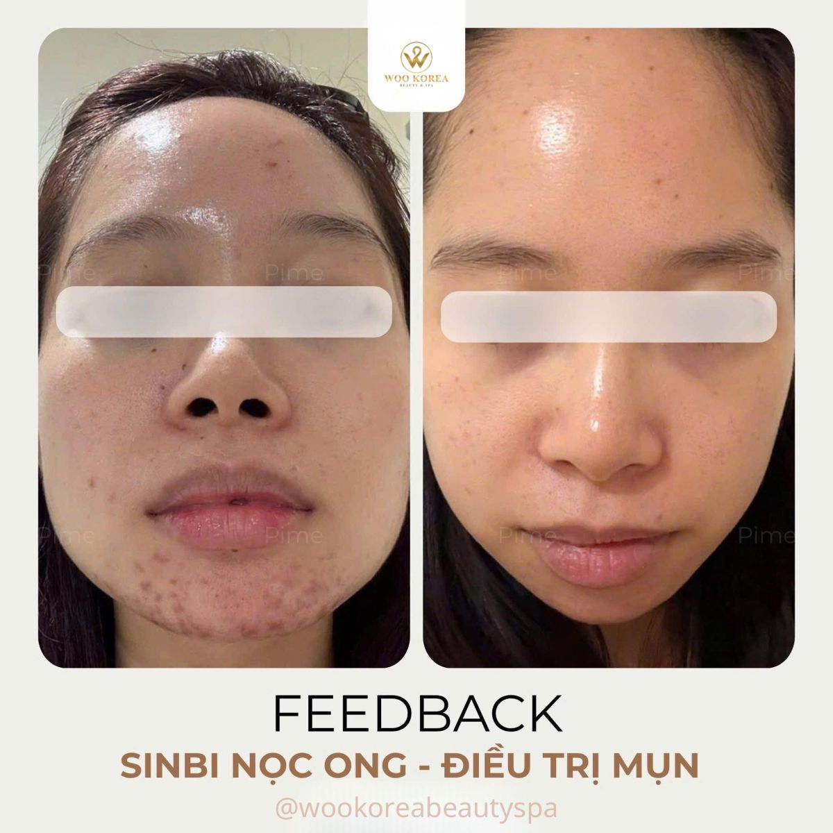 peel da trị mụn