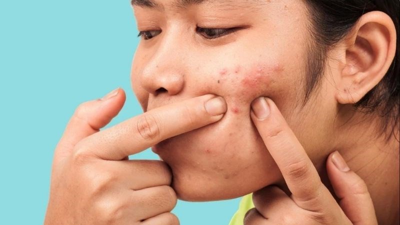 trị mụn