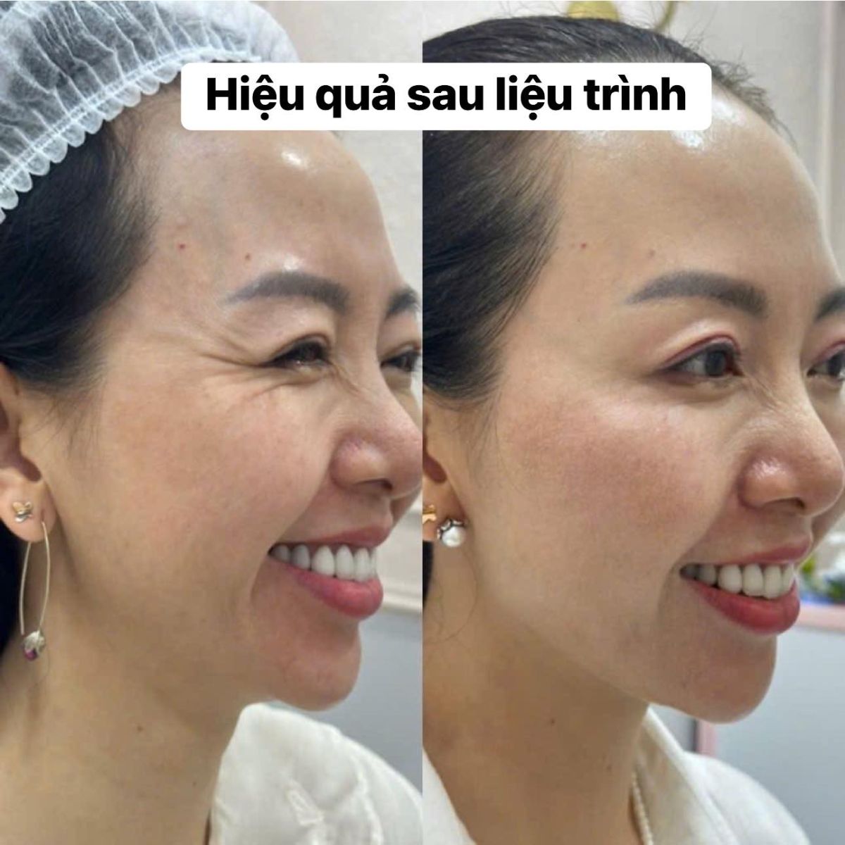 trẻ hóa da