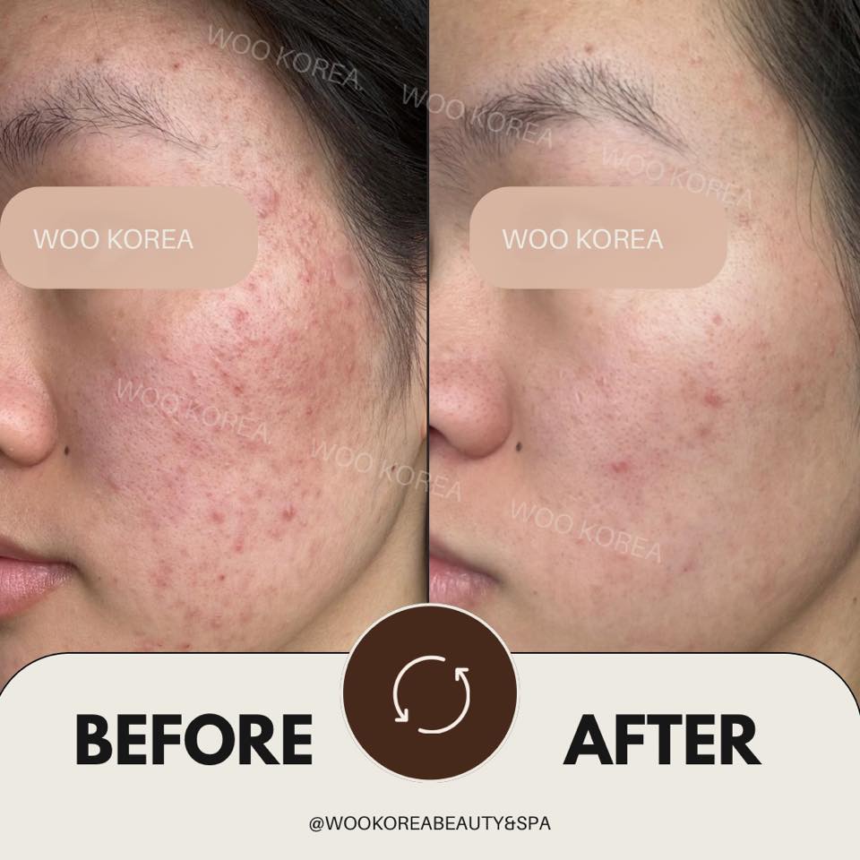 trị mụn không đau