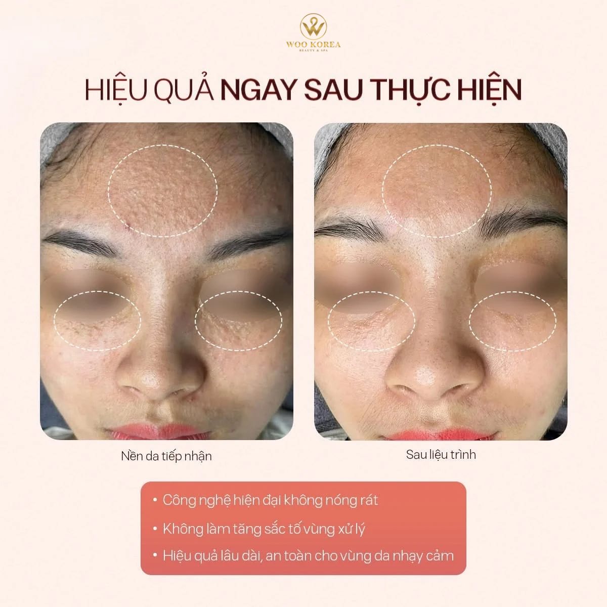 đốt mụn thịt