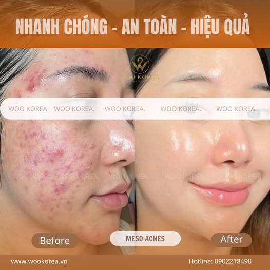 trị mụn