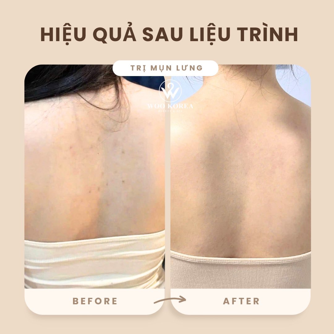 trị mụn lưng