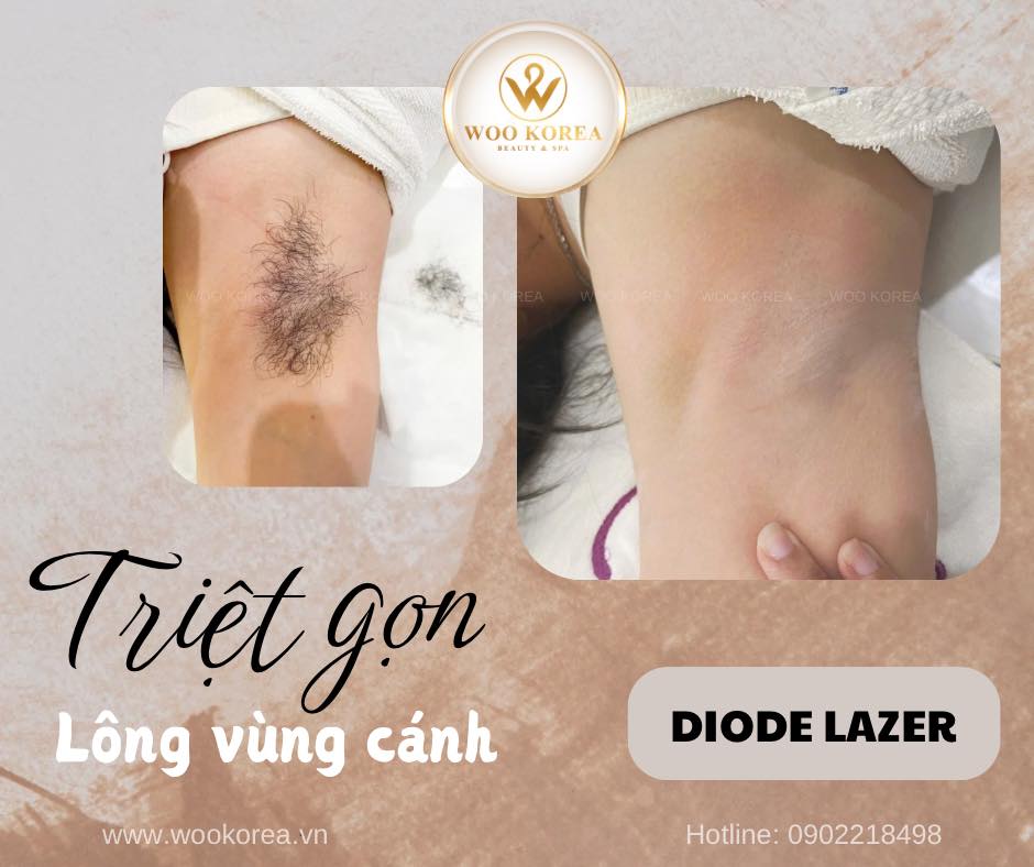 triệt lông