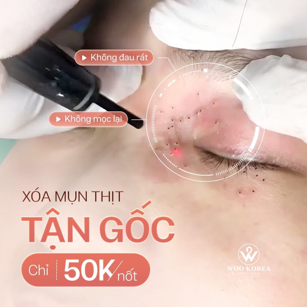 đốt mụn thịt